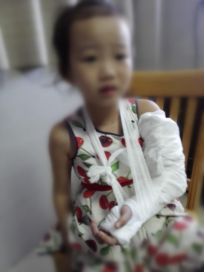 肱骨骨折取钢板怎样恢复,肱骨近端骨折切开复位内固定术