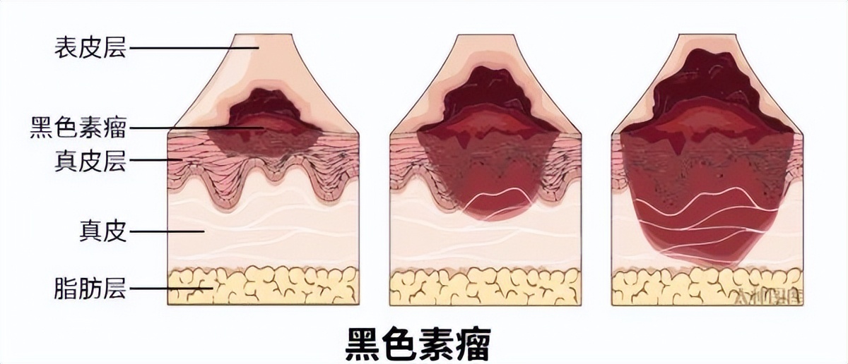 19种癌的早期信号和筛查建议——早知道能救命！
