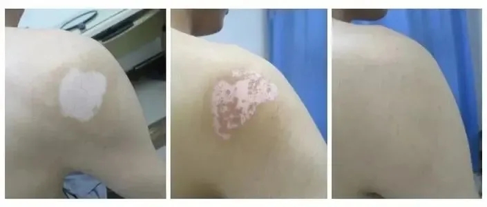 白癜风白斑部位该怎么护理,长白癜风吃什么好得快