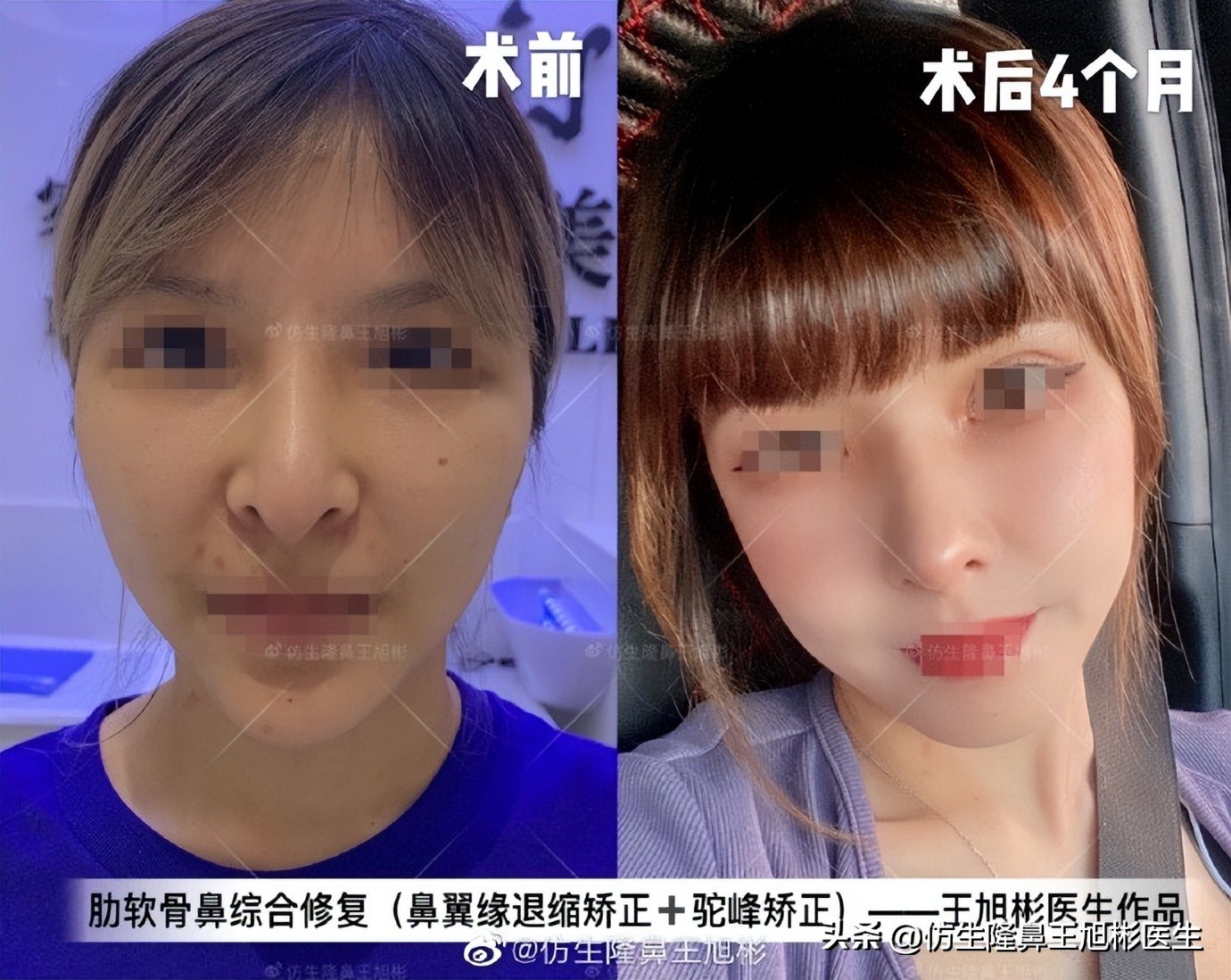 鼻翼缘退缩要如何矫正|王旭彬隆鼻