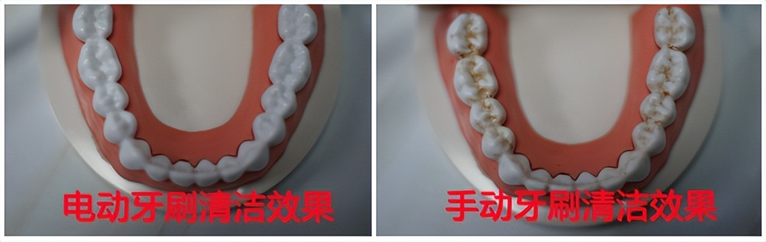 电动牙刷长期使用伤牙,电动牙刷会对补的牙有损伤吗
