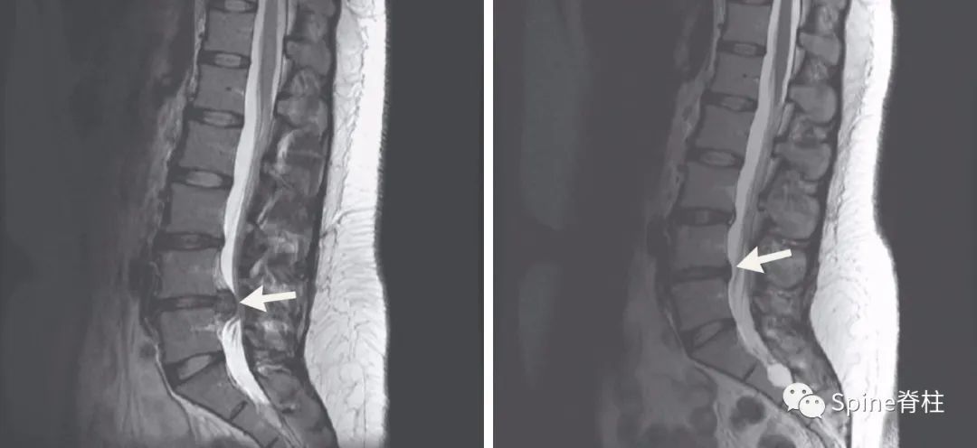 腰椎间盘突出症状表现,腰椎间盘突出症疼痛最佳止痛方法