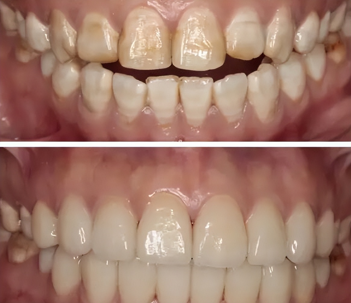 一分钟治愈牙齿黄斑,牙齿有病变怎么办