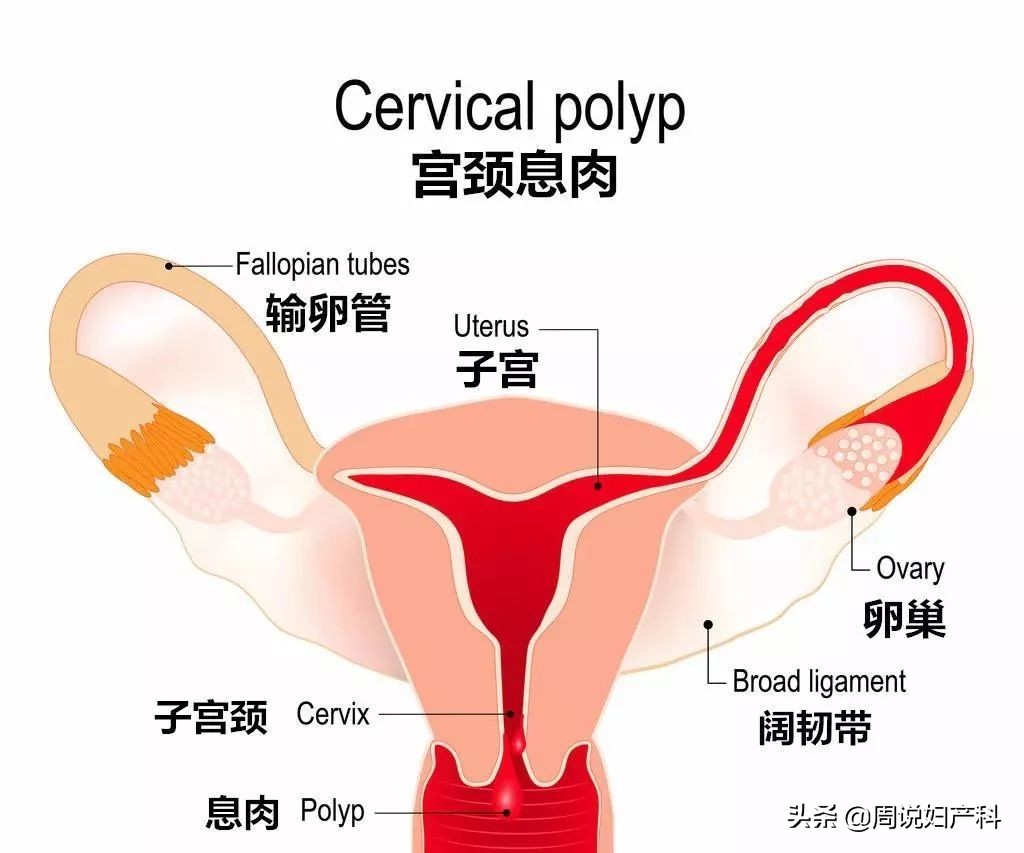 子宫息肉做宫腔镜手术需要多少钱,子宫里面为什么会长息肉