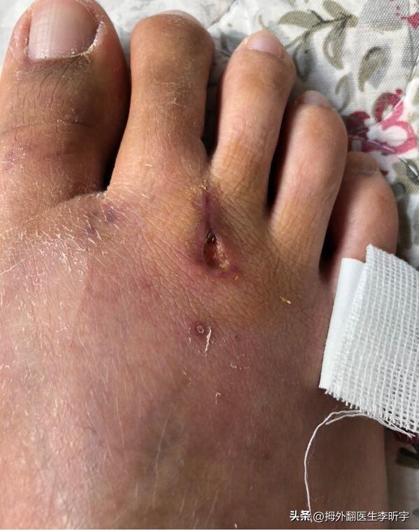 拇外翻手术拆线后伤口干裂怎么办,拇外翻术后肿得厉害怎么办