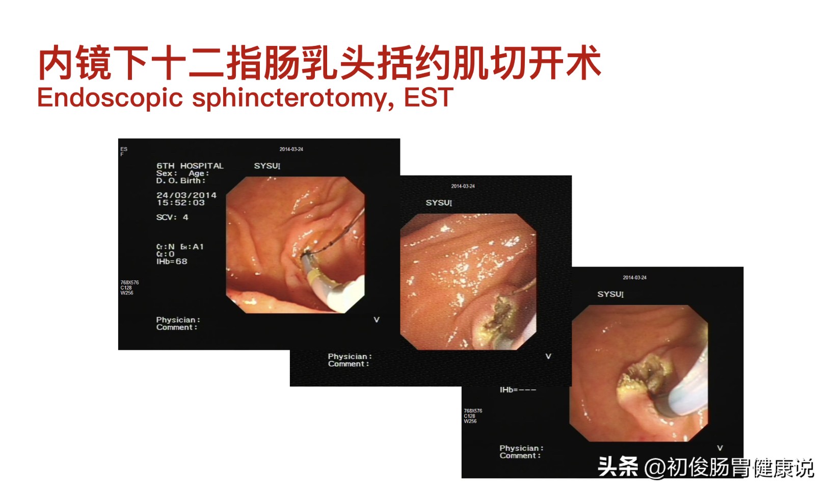消化内镜下施行的手术有哪些,消化内镜切除术怎么做