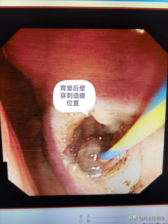 腹腔粘液癌治疗有妙招——万荣教授以内镜Notes技术成功胃减压