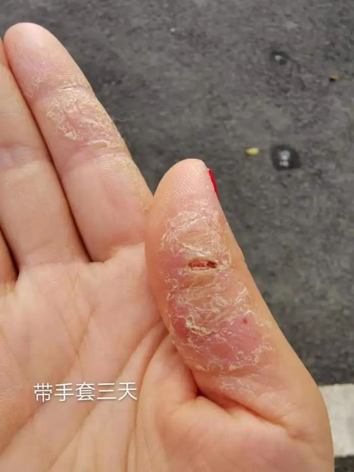 只需2步搞定宝宝湿疹,0-1岁祛湿疹的药