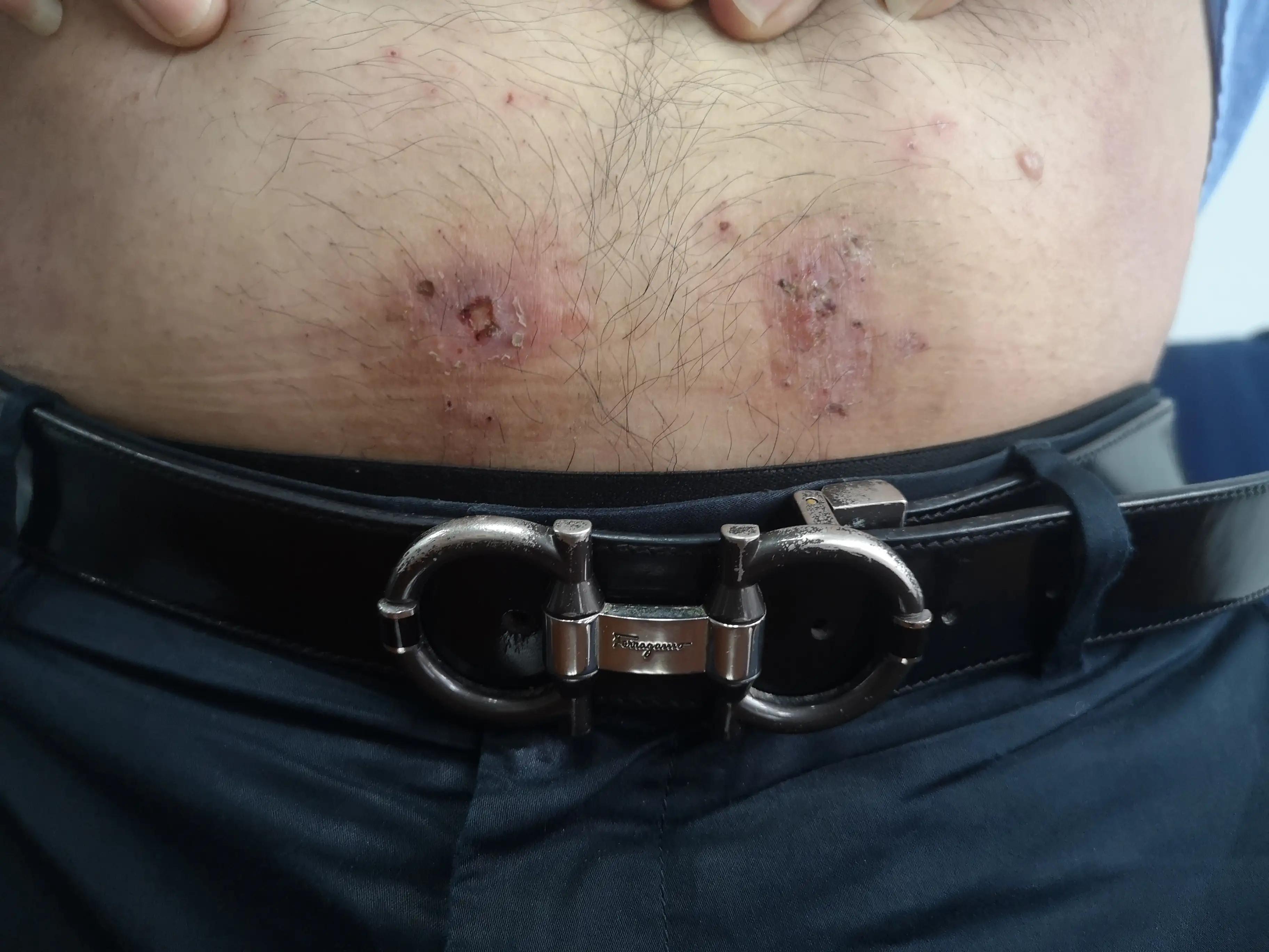 湿疹似乎是一种治不好的病,湿疹和痒疹是同一种病吗