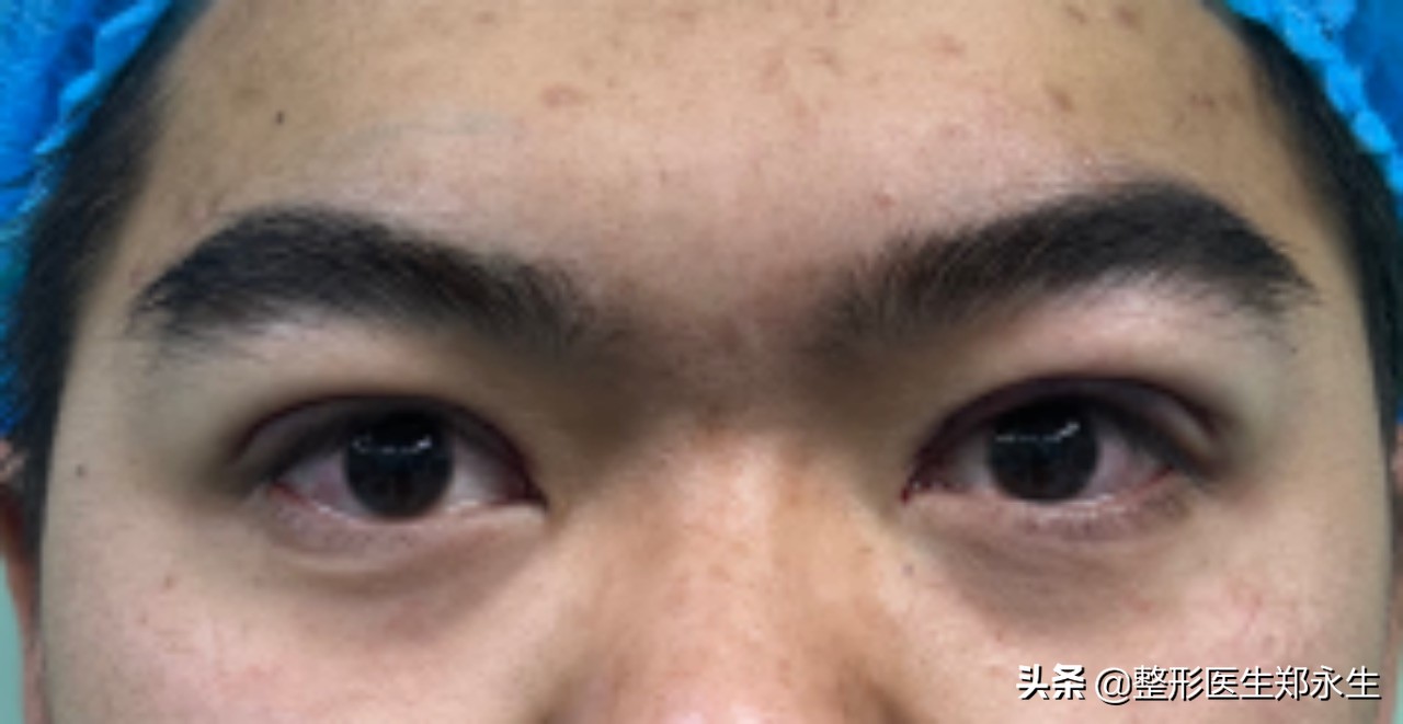 抬头纹为什么特别明显,抬头纹的科学原因