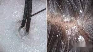 头皮屑特别多怎么去除最简单方法,头皮屑又多又痒怎么去除最有效