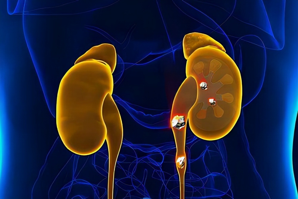 4.5毫米的结石一直掉不下来,4公分结石有多大