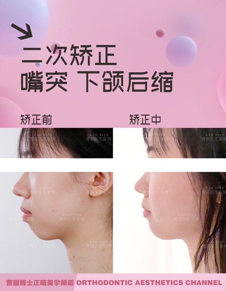 凸嘴下巴后缩拔牙改善有什么坏处,深覆合嘴凸下巴后缩矫正要拔牙吗