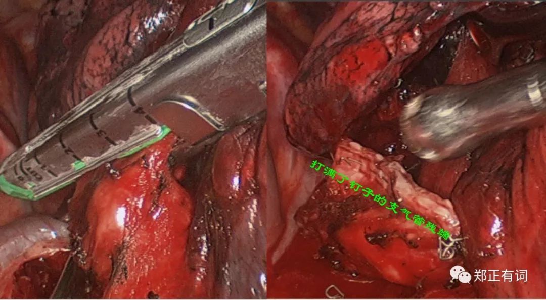 肺部切除手术对寿命的影响,肺部手术对心脏有影响吗
