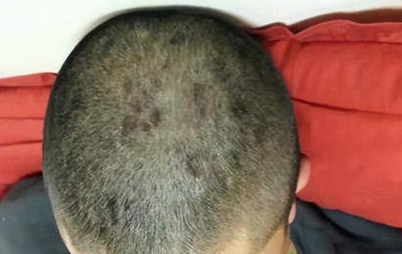 头上起疙瘩有脓包还掉发什么原因,老人头上总是起脓包疙瘩