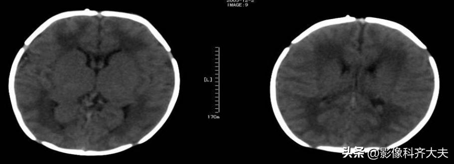 新生儿缺氧缺血性脑病的mr诊断,新生儿缺血缺氧脑病的ct表现