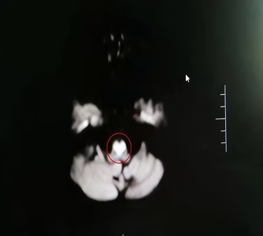 河北保定:市第一中心医院成功救治一例罕见的“心形”脑梗死患者