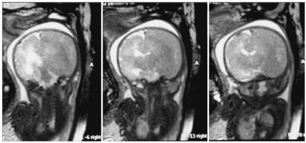 孕期肚子被撞了一下轻微出血,孕妇血肿20毫米危险吗