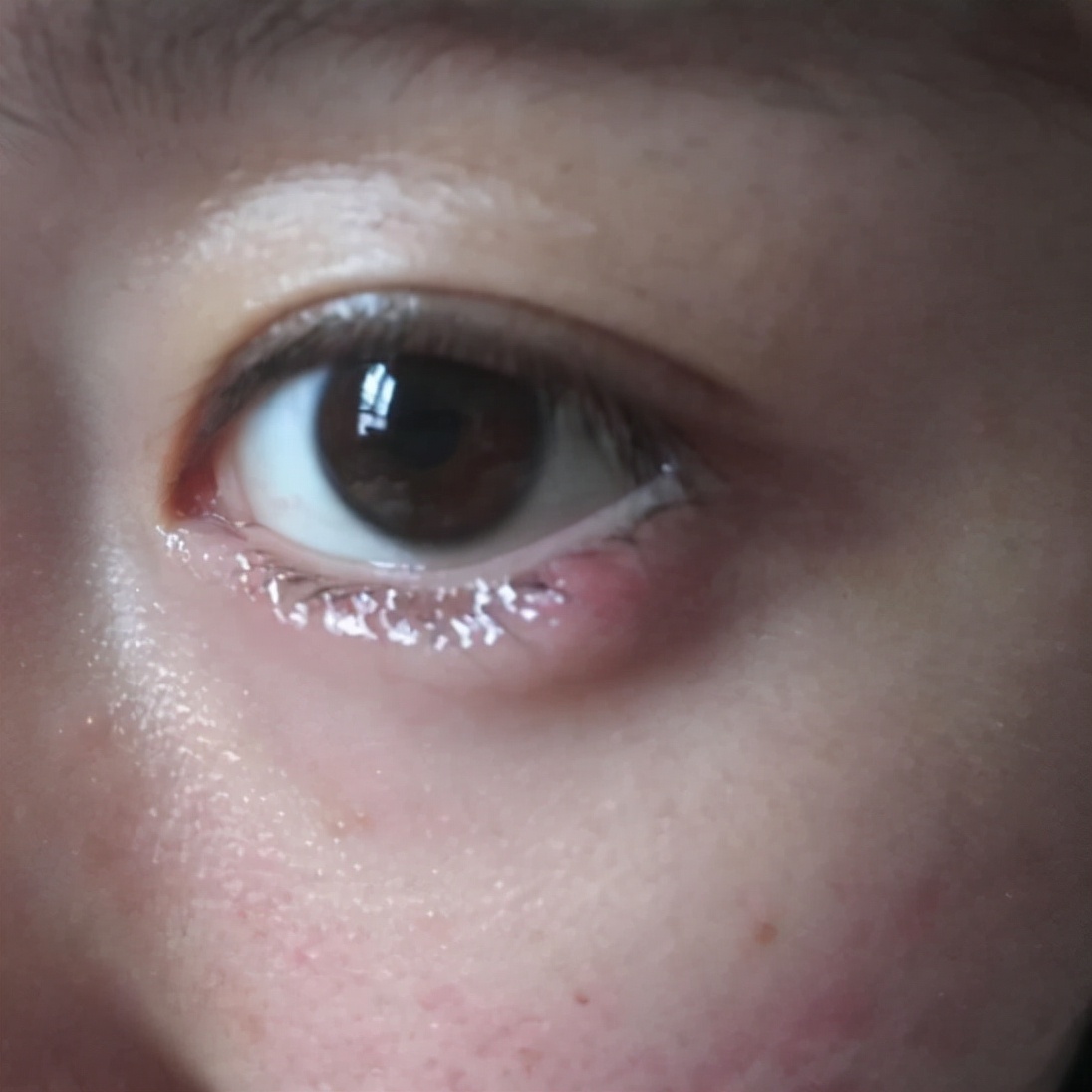 几块钱一支的红霉素眼膏,到底能治多少病?答案来了