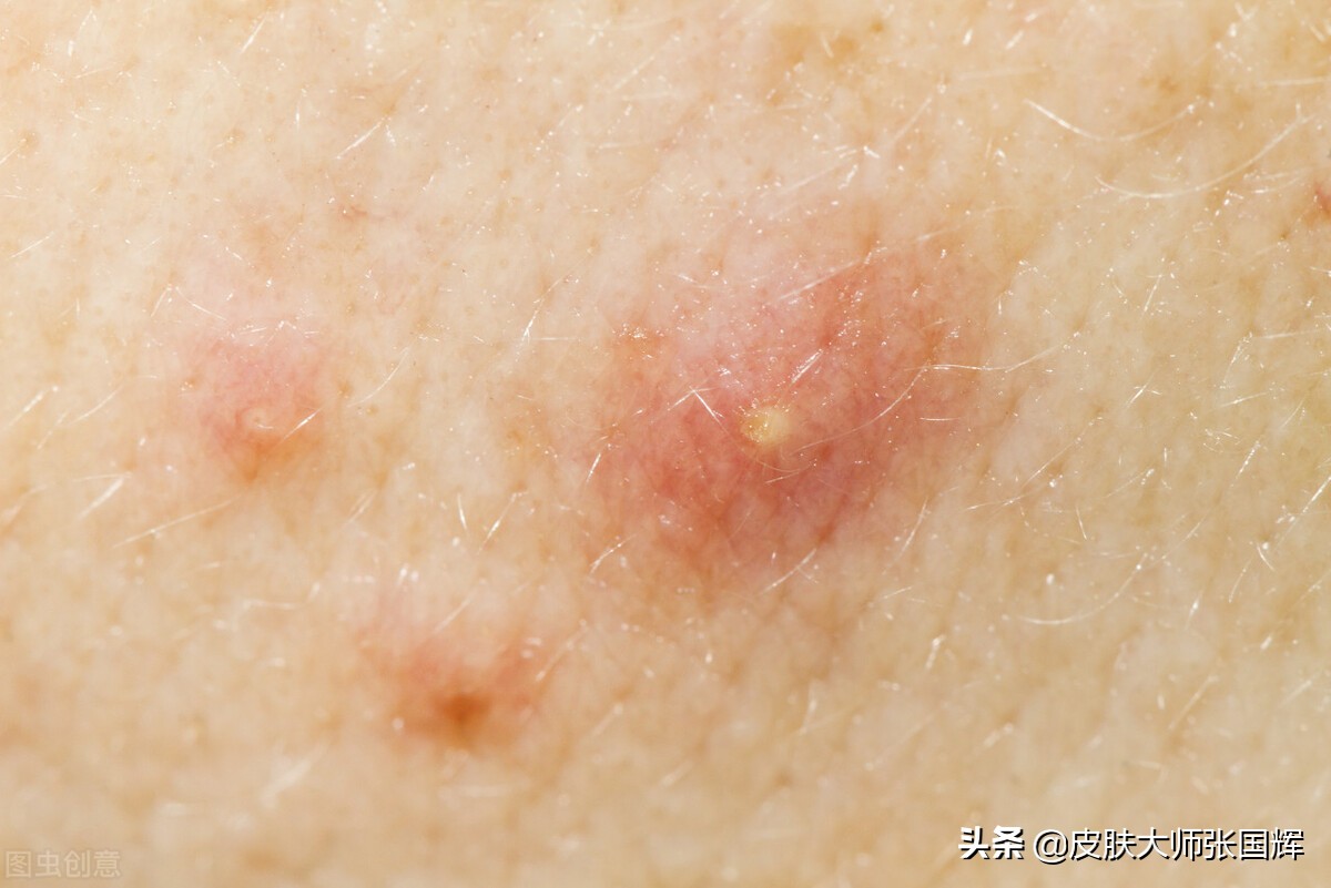 各种痘痘类型及治疗方法,各种痘痘类型治疗方法