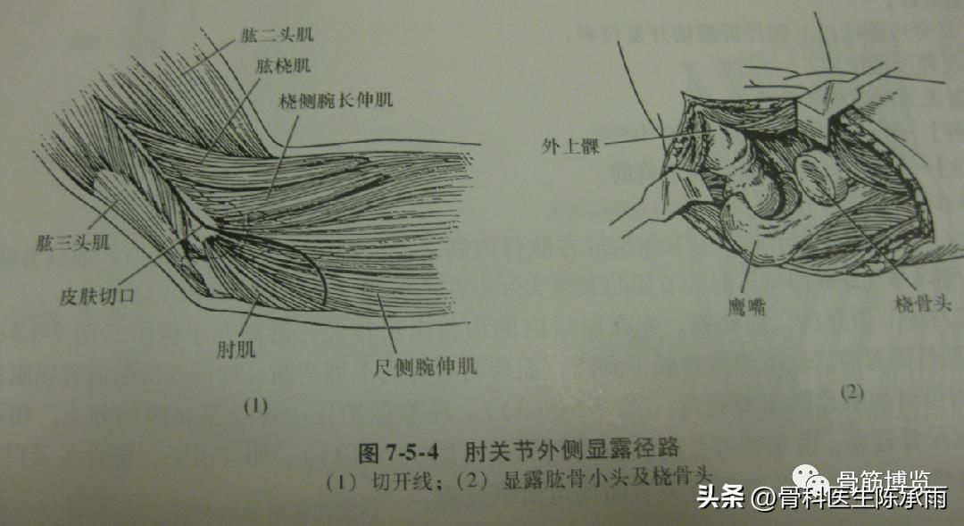 肘关节恐怖三联征最新治疗方法,肘关节恐怖三联征最佳治疗方法