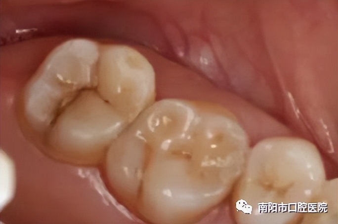 医生问你牙怎么这么不好,医生说我的牙齿裂开了怎么治疗