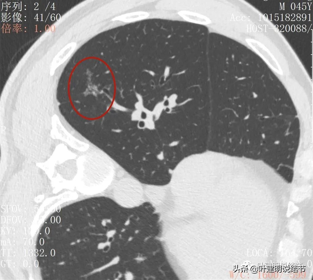 误诊肺纤维化,肺蜂窝状是癌吗