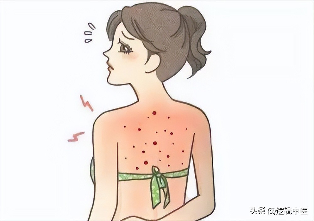 脸上的痘痘一直很红,脸上的痘痘一定要挤掉吗