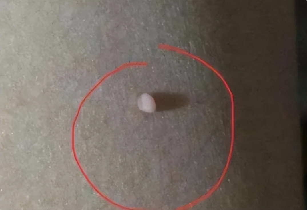 脖子上的小肉粒揪掉后会怎样,脖子上透明小肉粒可以揪下来