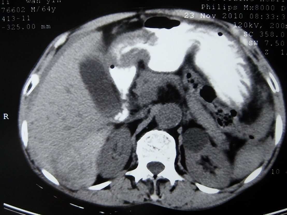 胃穿孔的症状及治疗方法,胃穿孔什么治疗方法好