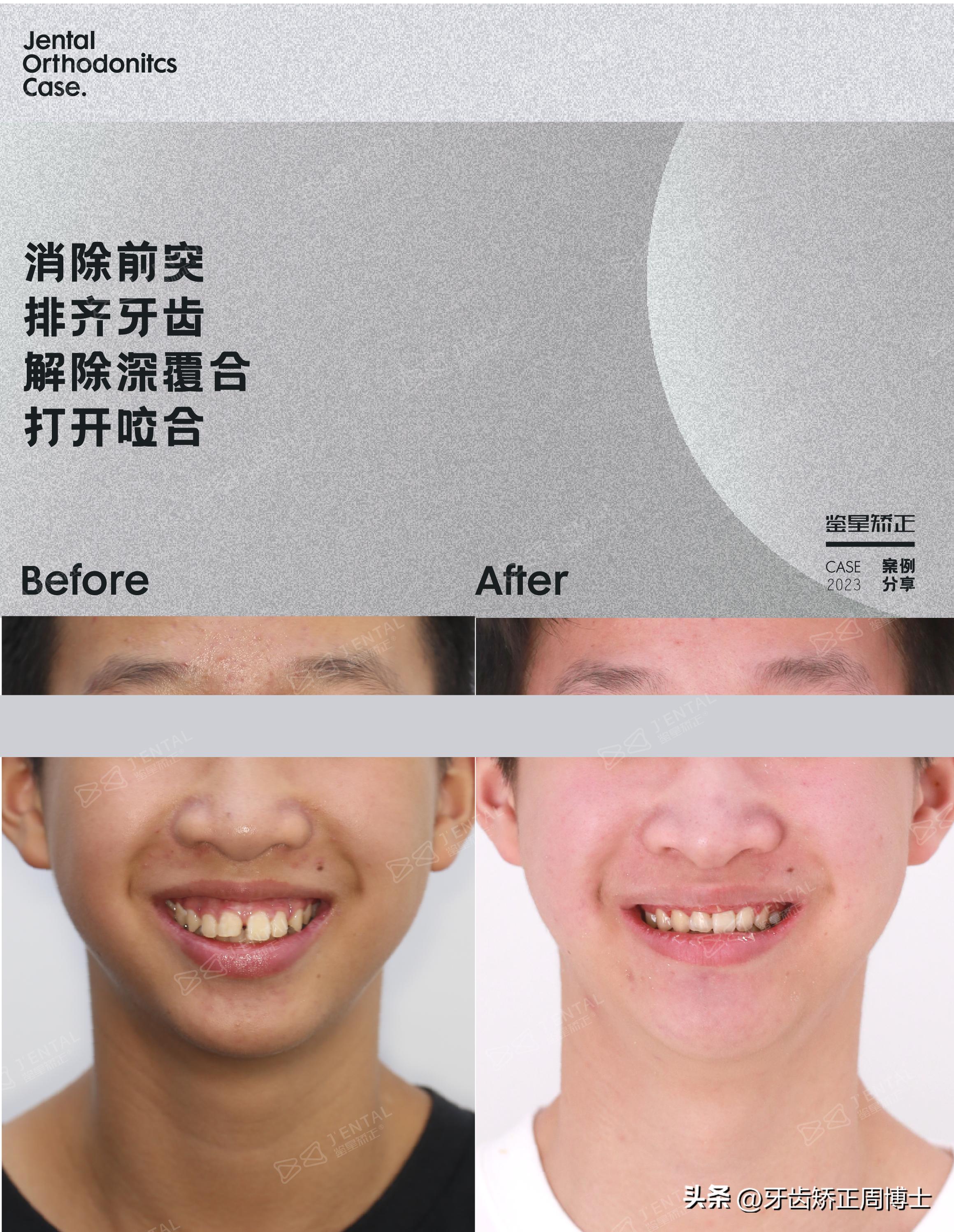 拔掉大牙做矫正好还是植牙好,拔掉4颗牙齿正畸收缝有几种方法