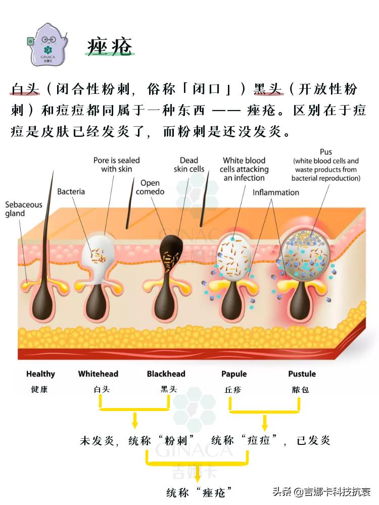 如何祛痘妙招,最简单高效祛痘方法