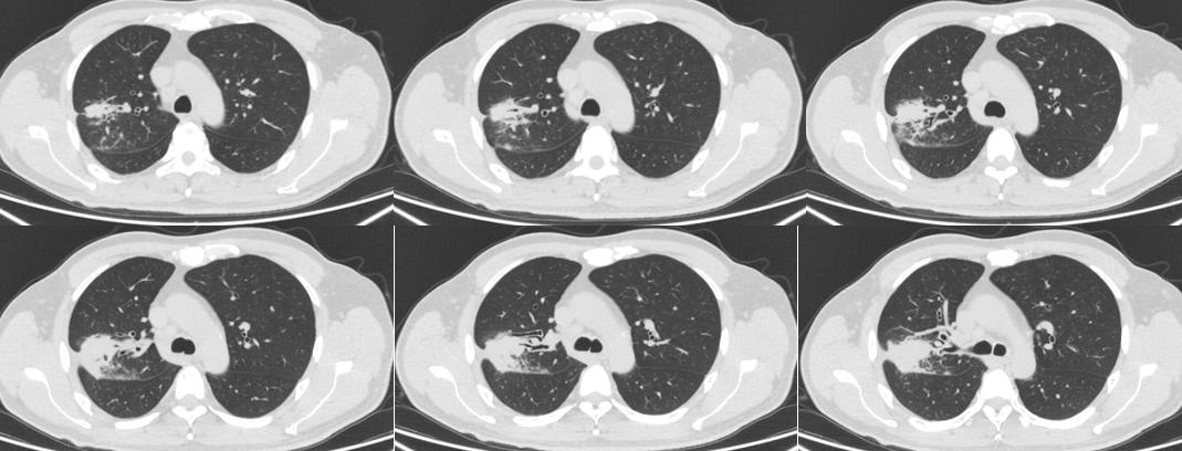机化性肺炎用药多久复查ct,坠积性肺炎ct表现