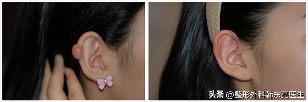 脸部疤痕最好的修复方法,修复凹陷疤痕的最好方法