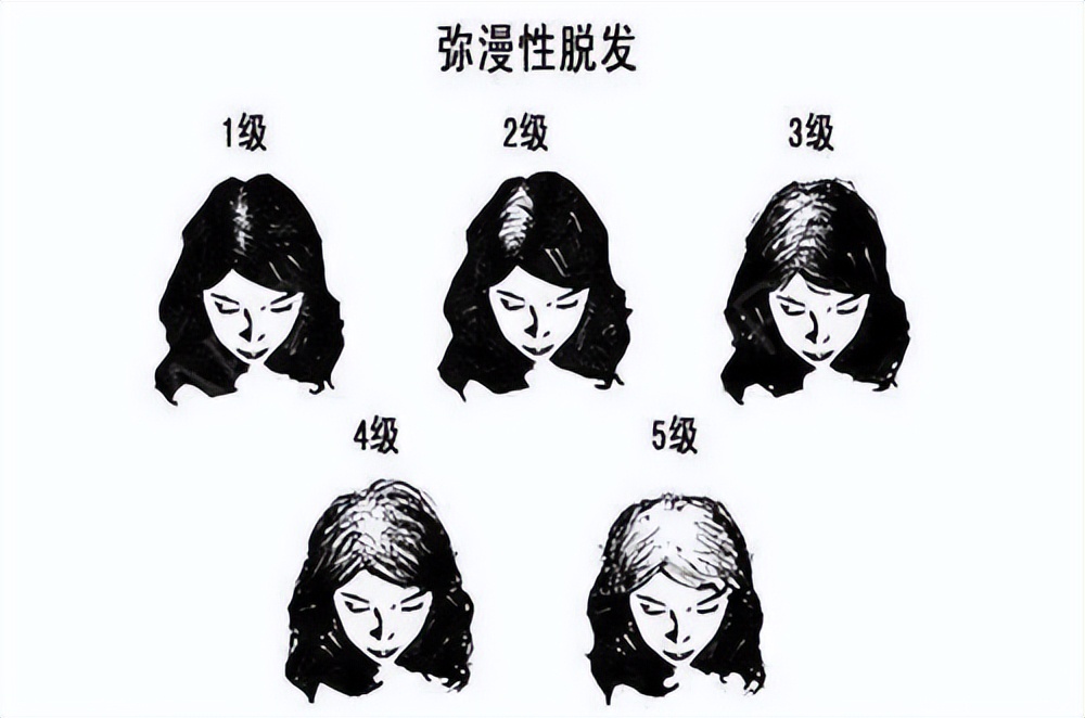 秃星人必看！大麦植发告诉你，不同部位脱发应如何对症治疗？