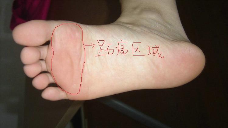 小孩脚底板磨出茧子走路特别疼,脚底板爱进风什么原因