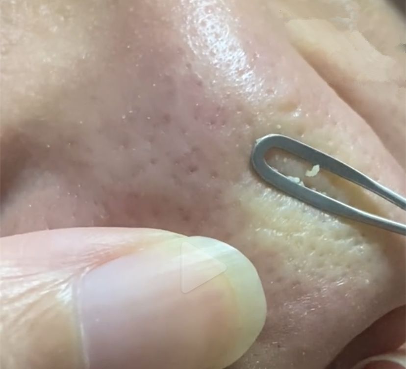 真黑头怎么去,黑头用黑头膏为什么去不掉黑头