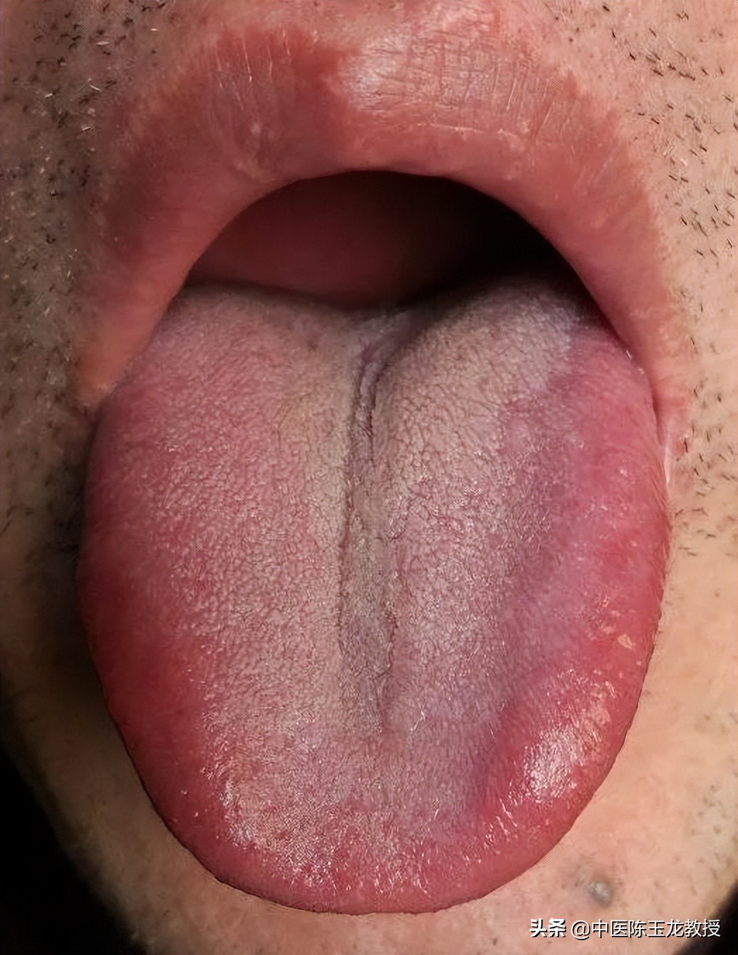 大肠湿热和膀胱湿热吃什么中成药,脾胃湿热和肝胆湿热同治的中成药