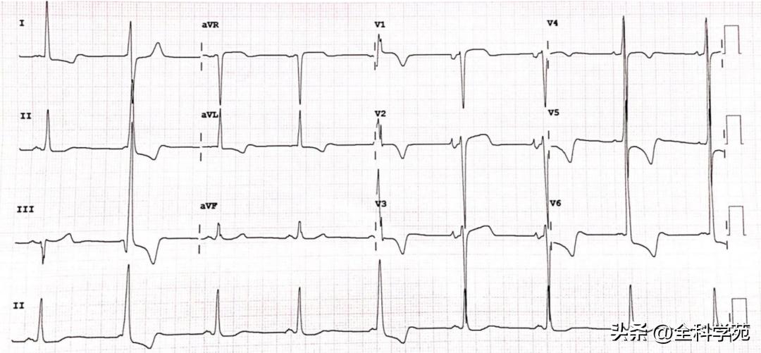 t波倒置三种常见原因,t波低平倒置有事吗
