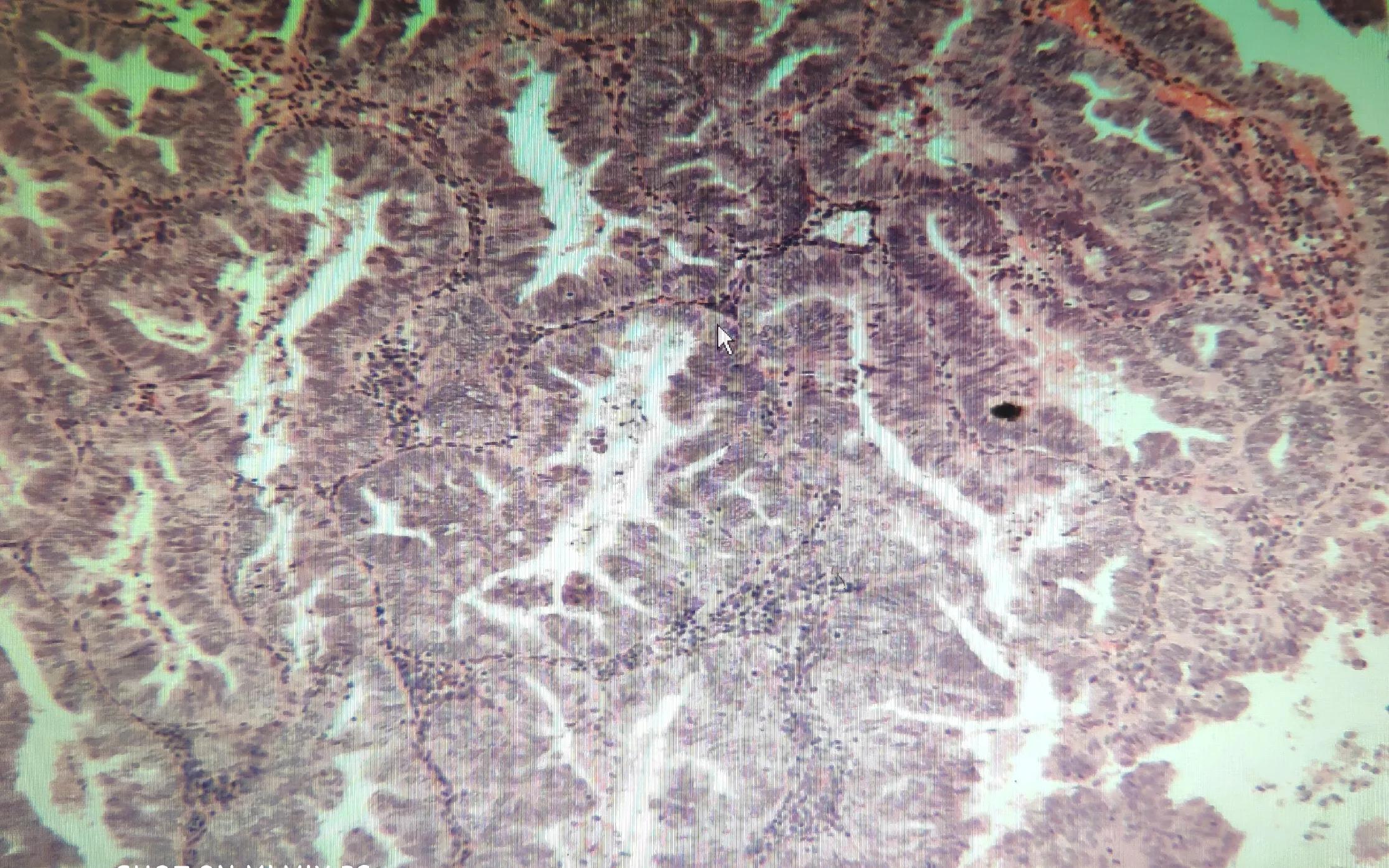 子宫内膜癌肥胖,27岁患子宫内膜癌能治愈吗