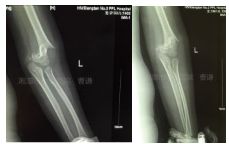 肱骨骨折取钢板怎样恢复,肱骨近端骨折切开复位内固定术