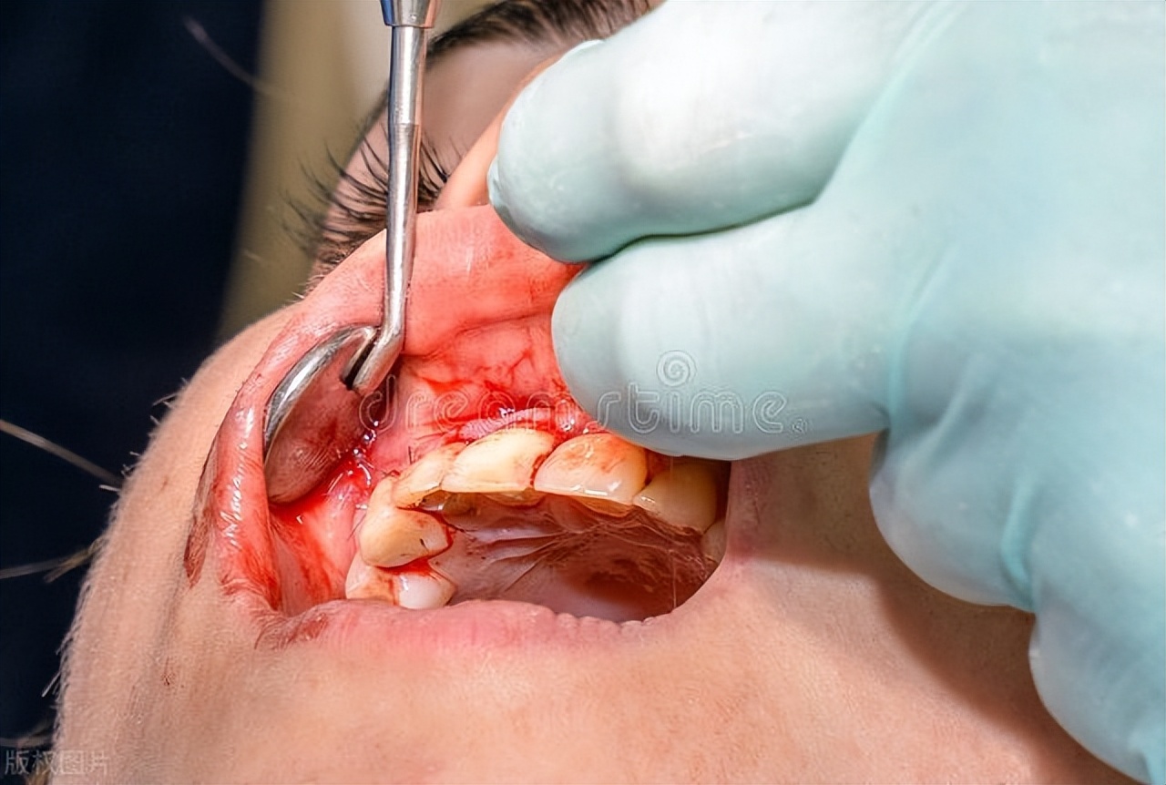 牙神经杀死后戴牙套几年后牙疼,杀死牙神经的过程是不是比较疼