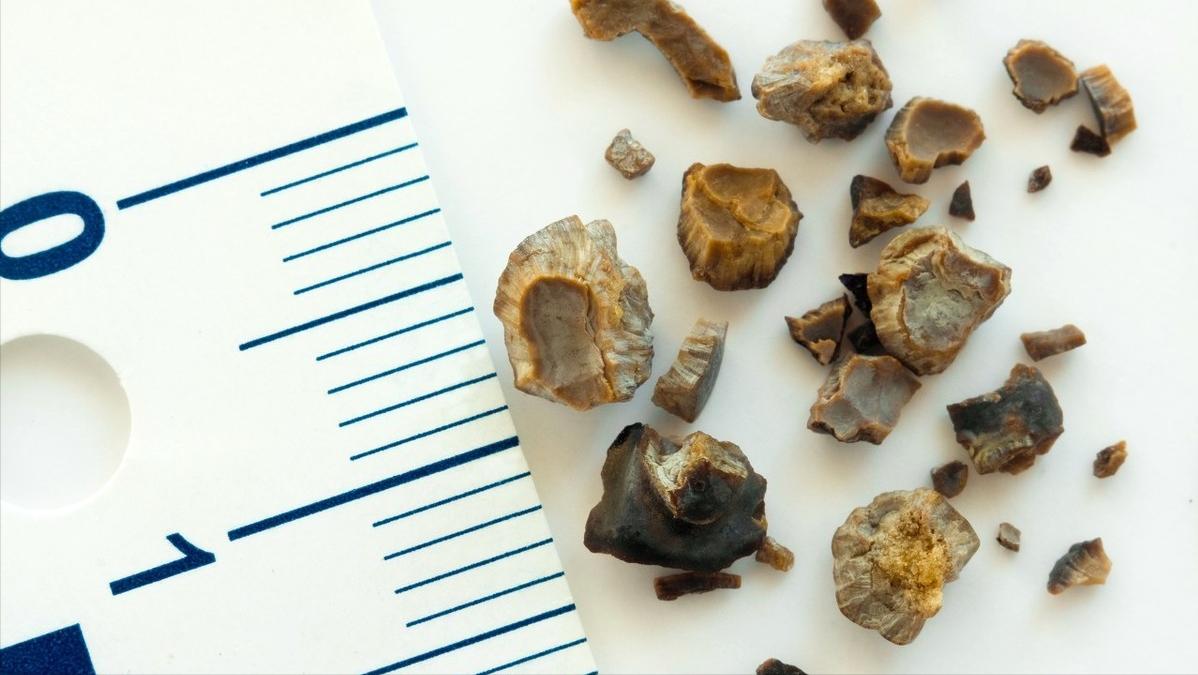 泌尿系统结石是什么原因导致的,泌尿系统结石的症状是什么