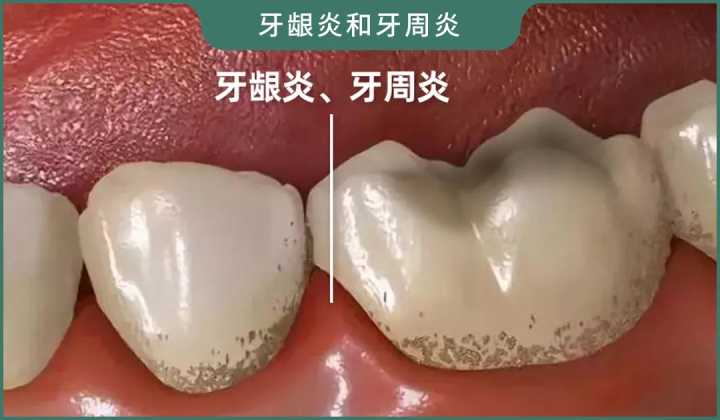 水牙线对比测评,高科技与智商税