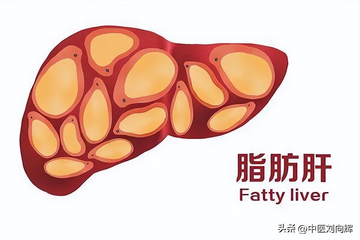 脂肪肝对应中成药,脂肪肝健脾除湿的中成药