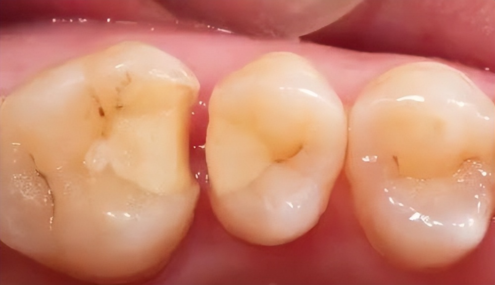 牙齿掉了一小块怎么办,拔牙掉了一块肉怎么办