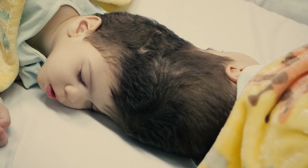 巴西连体双胞胎成功分离后续,巴西头部连体婴儿分离后续