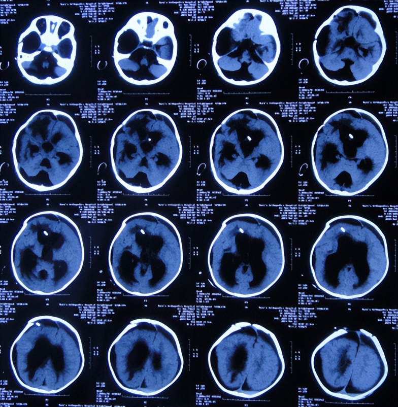 蛛网膜囊肿合并脑积水腹腔分流术,治疗蛛网膜囊肿引起脑积水严重吗