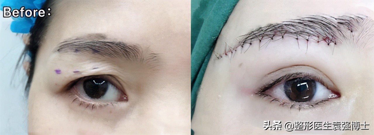 三角眼眼皮松弛怎么做好看,45岁上眼皮松弛下垂出现三角眼