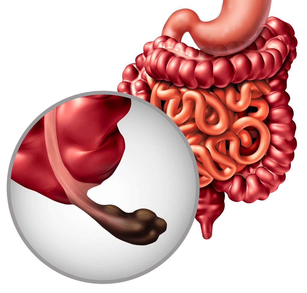 大便总是很臭是什么原因,大便馊味是消化不良吗